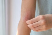 Nuevas terapias para la dermatitis atópica